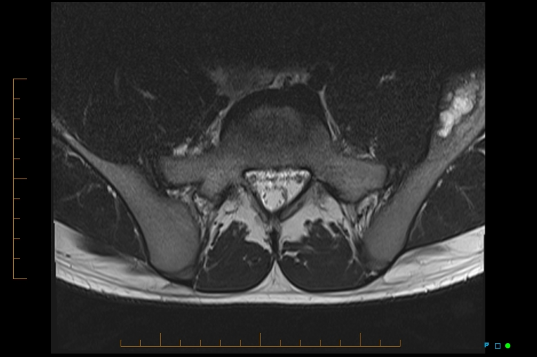 Figure 4 for case Fibrous dysplasia